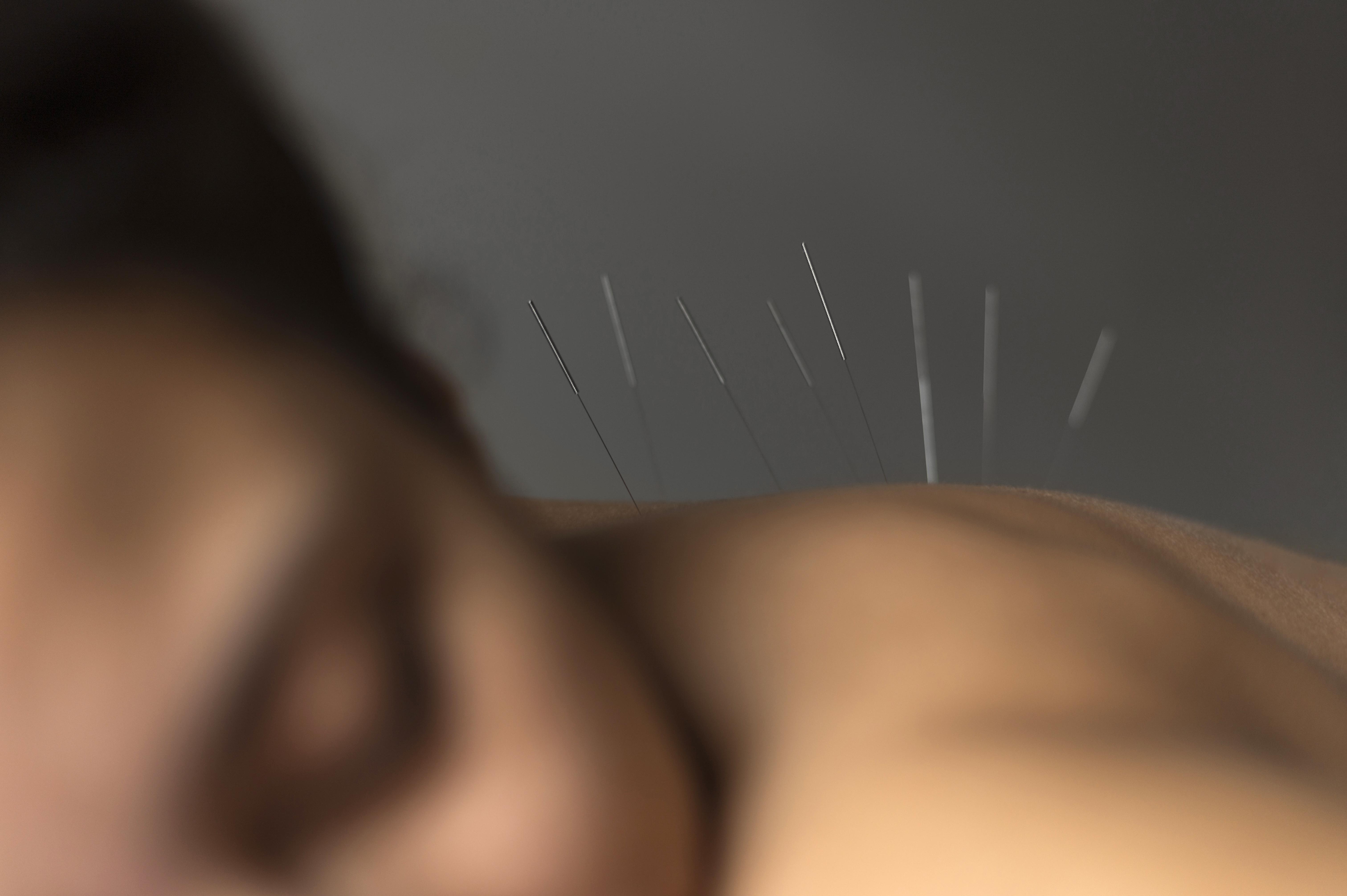 image from Physiotherapy Acupuncture